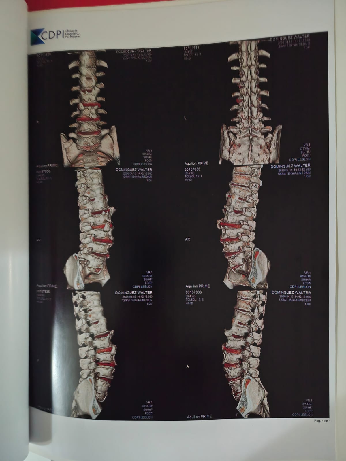 Imagem de tomografia da coluna vertebral